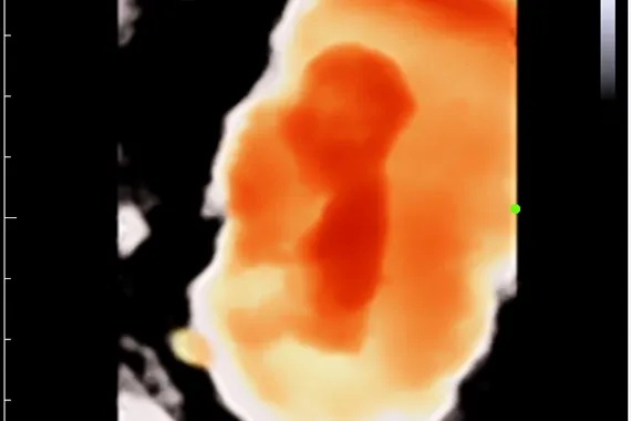 Клинические изображения УЗИ аппарат Mindray DC-45