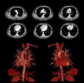Клинические изображения Canon Aquilion ONE PRISM Edition компьютерный томограф