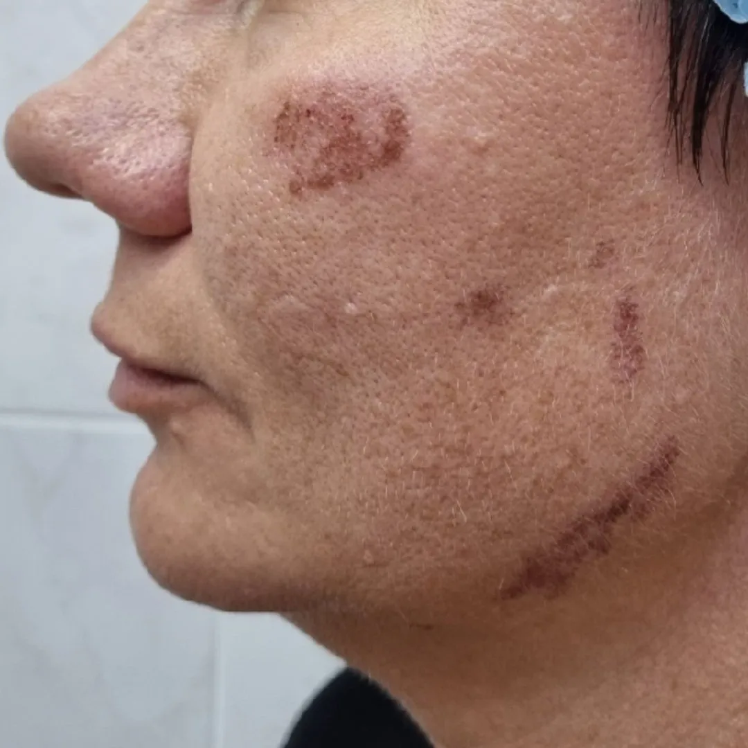 NeoGen омоложение лево до.jpg