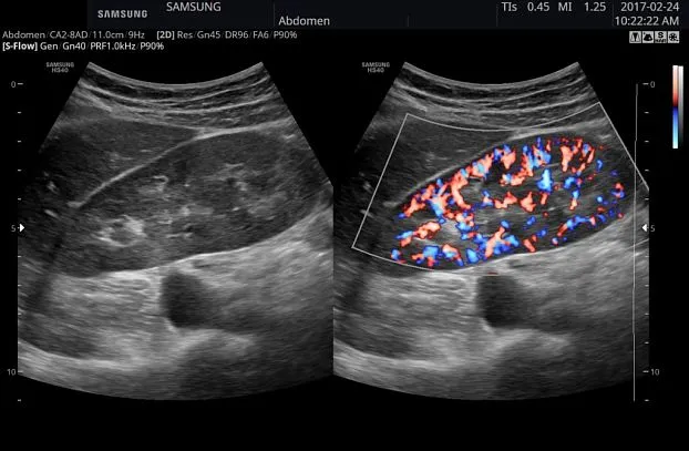 Клинические изображения Samsung Medison HS40 УЗИ аппарат