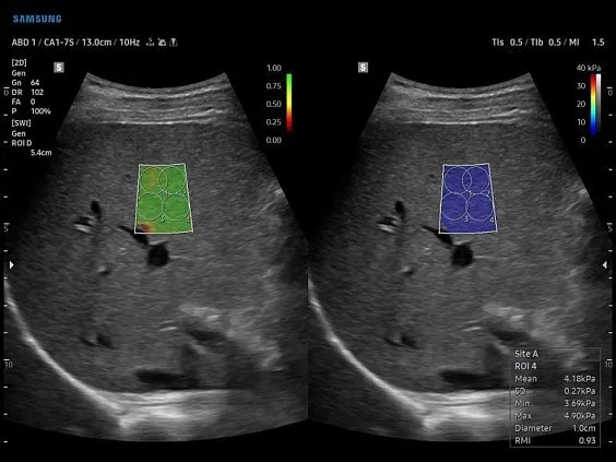 Клинические изображения Samsung Medison V7 УЗИ аппарат