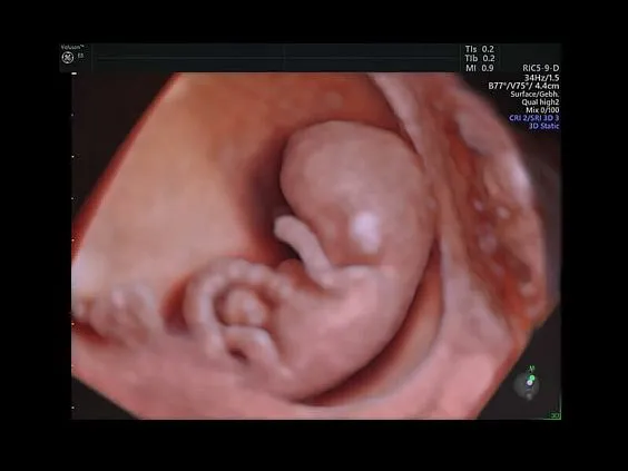 Клинические изображения УЗИ аппарат GE HealthCare Voluson E8 