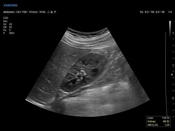 V6-RUS: Печень, EzHRI