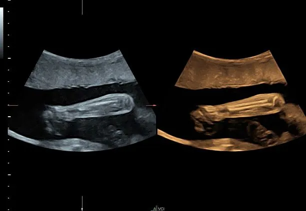 Клинические изображения УЗИ аппарат GE HealthCare Voluson S10