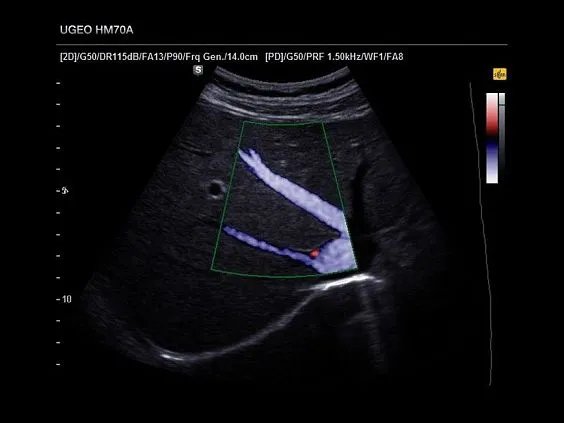 Клинические изображения Samsung Medison HM70A УЗИ аппарат портативный