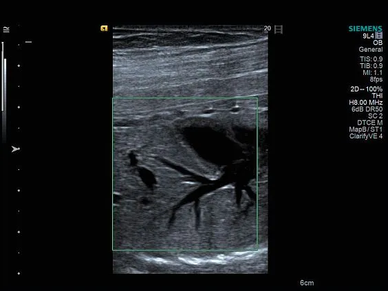 Клинические изображения Siemens Acuson S1000 ультразвуковая система