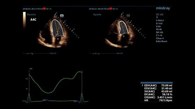 Клинические изображения УЗИ аппарат Mindray DC-80 X-insight