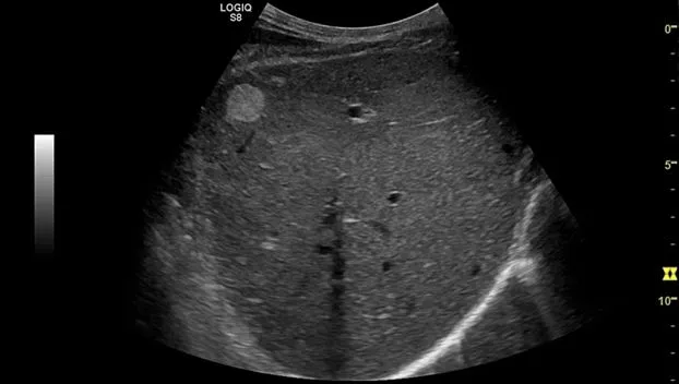 Клинические изображения Ультразвуковая диагностическая система GE Logiq S7 XDclear