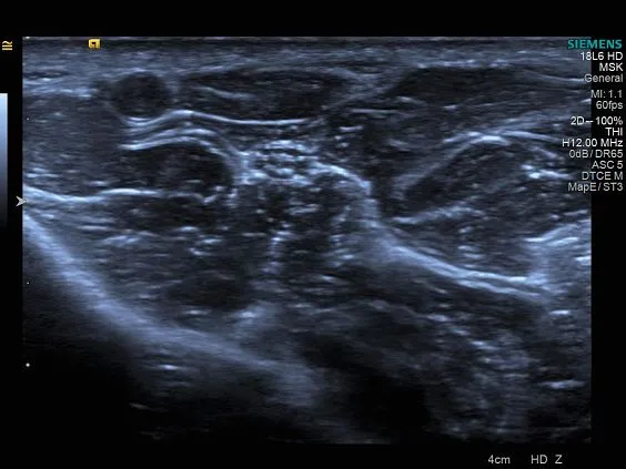 Клинические изображения Siemens Acuson S1000 ультразвуковая система