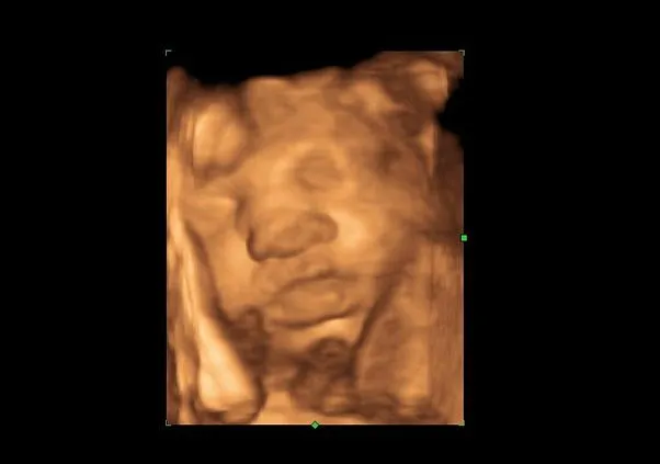 Клинические изображения GE Logiq P9 ультразвуковая диагностическая система