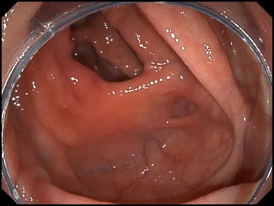 Клинические изображения SonoScape HD-500 видеоэндоскопическая система