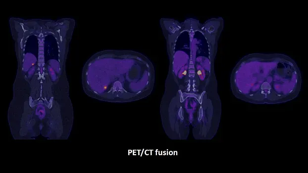 Клинические изображения Siemens Biograph Vision ПЭТ-КТ