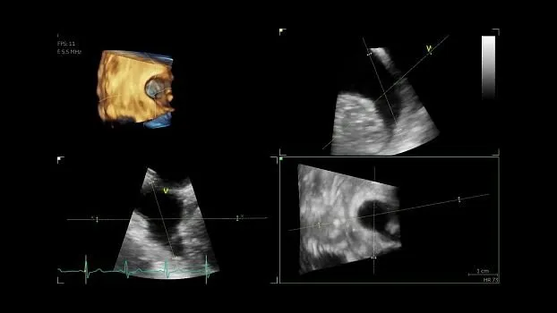 Клинические изображения GE Vivid S70 УЗИ аппарат