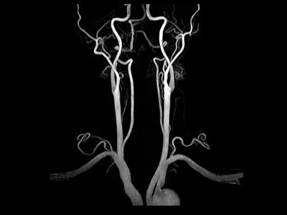 Клинические изображения МРТ аппарат GE SIGNA Explorer 1.5T