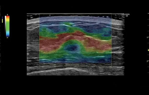 Клинические изображения GE Logiq S8 XDclear ультразвуковая диагностическая система