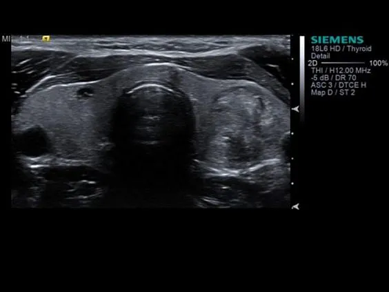 Клинические изображения Siemens Acuson S3000 ультразвуковая система