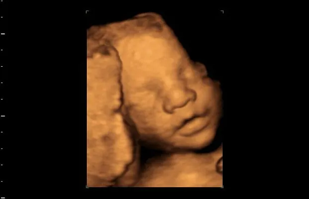 Клинические изображения GE Logiq P9 ультразвуковая диагностическая система