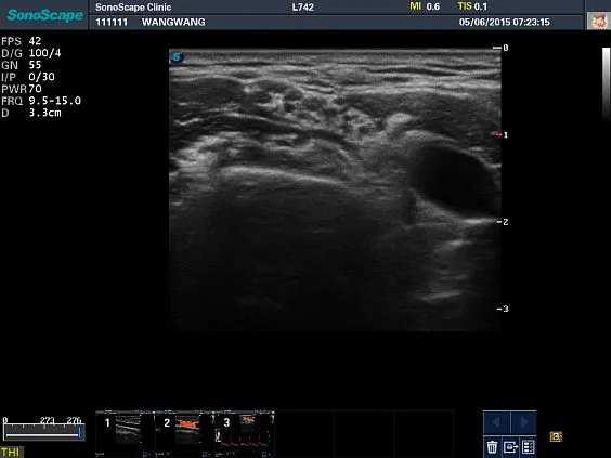 Клинические изображения Sonoscape S8 Exp ультразвуковой аппарат