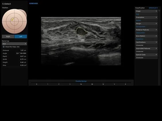 Клинические изображения Samsung Medison V7 УЗИ аппарат