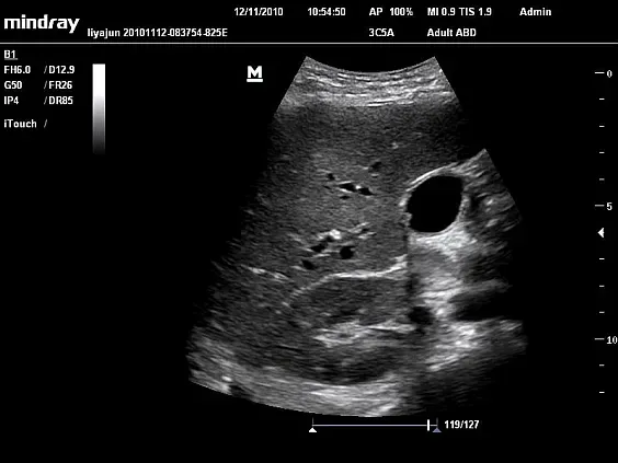 Клинические изображения УЗИ аппарат Mindray DC-N6