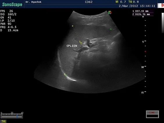 Клинические изображения Sonoscape S9 ультразвуковой аппарат