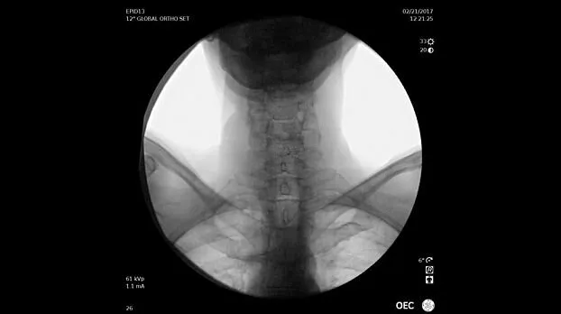 Клинические изображения Рентгенохирургический аппарат типа С-дуга GE OEC Elite II
