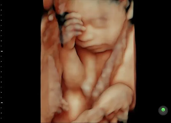 Клинические изображения GE Voluson S6 аппарат УЗИ