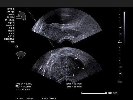 Клинические изображения Ультразвуковая система Siemens Acuson NX3
