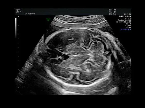 Клинические изображения УЗИ аппарат GE HealthCare Voluson E8 