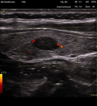 Клинические изображения GE Venue 50 аппарат УЗИ портативный