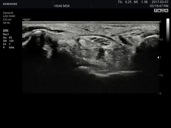 Клинические изображения Samsung Medison HS40 УЗИ аппарат