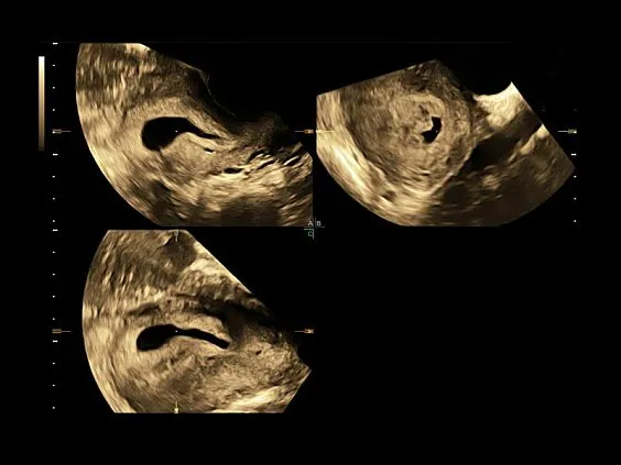 Клинические изображения GE Voluson S8 ультразвуковой аппарат