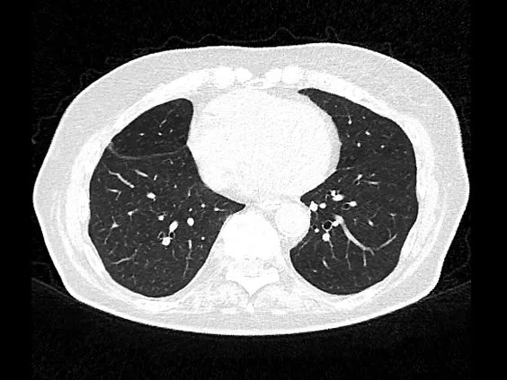 Клинические изображения Siemens SOMATOM go.Now компьютерный томограф