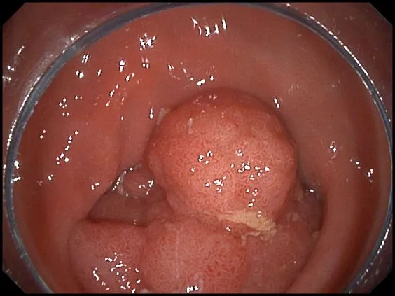 Клинические изображения SonoScape HD-500 видеоэндоскопическая система