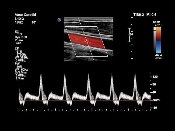 Клинические изображения Philips Affiniti 70 ультразвуковой аппарат