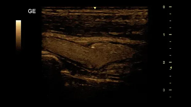 Клинические изображения УЗИ аппарат GE Healthcare Versana Essential 