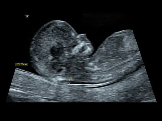 Клинические изображения GE Voluson S8 ультразвуковой аппарат