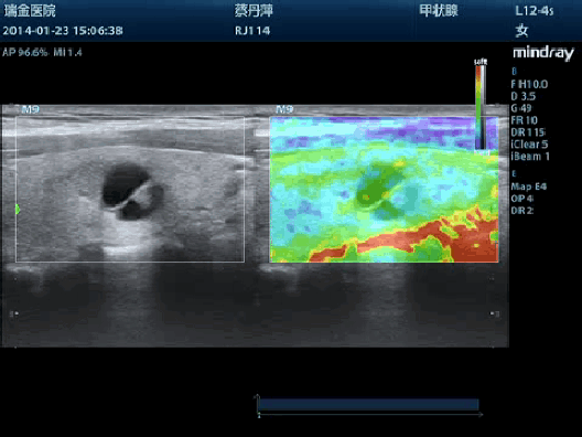 Клинические изображения УЗИ аппарат Mindray M9T портативный