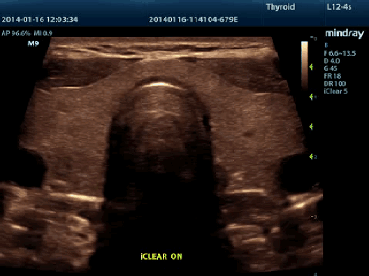 Клинические изображения УЗИ аппарат Mindray M9T портативный