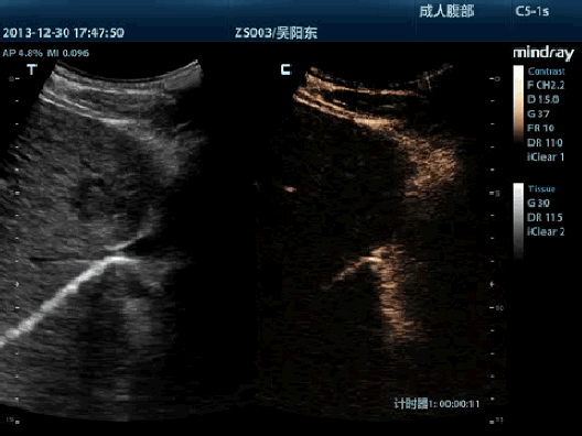 Клинические изображения УЗИ аппарат Mindray M9T портативный