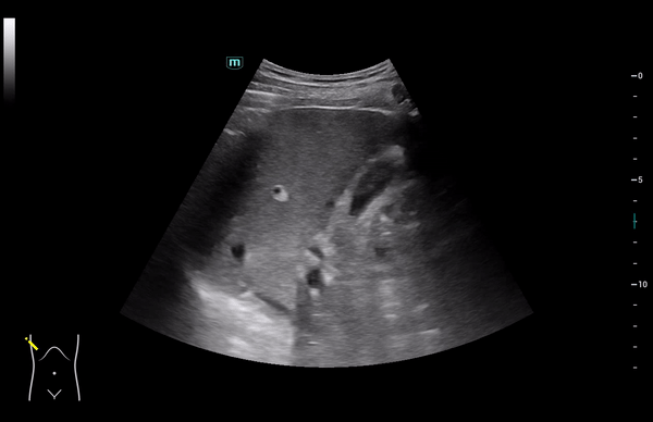 Клинические изображения УЗИ аппарат Mindray Consona N8