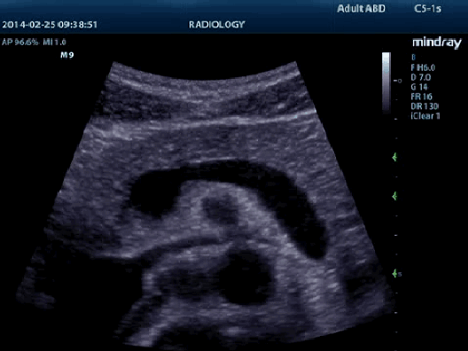 Клинические изображения УЗИ аппарат Mindray M9T портативный