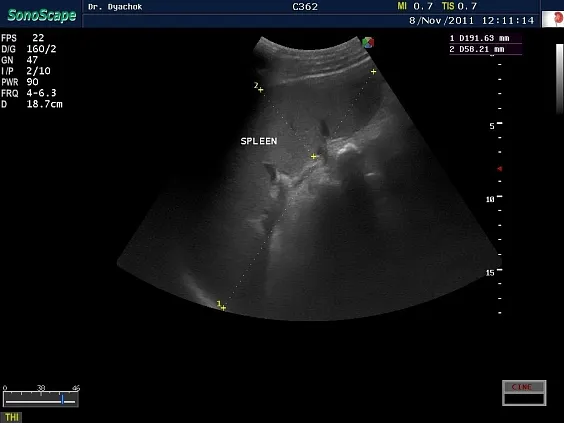 Клинические изображения Sonoscape S40 Exp ультразвуковой аппарат