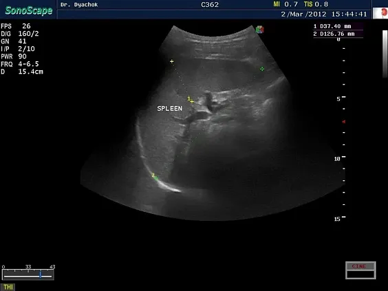 Клинические изображения Sonoscape S35 ультразвуковой аппарат