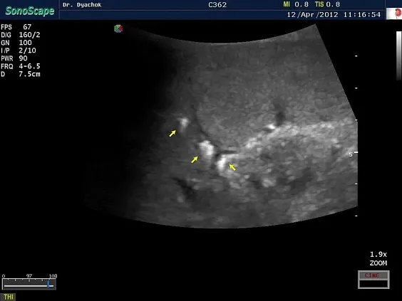 Клинические изображения Sonoscape S15 ультразвуковой аппарат