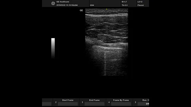Клинические изображения УЗИ аппарат GE Healthcare Versana Active портативный