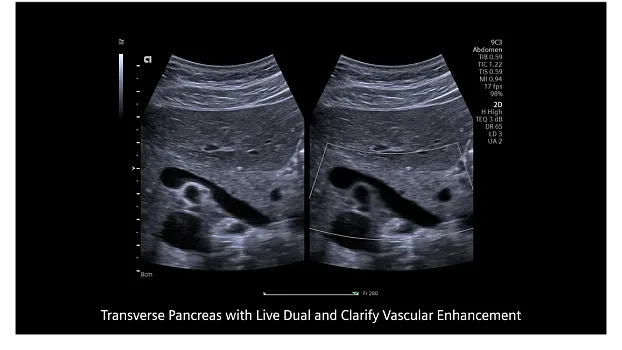 Клинические изображения Siemens Redwood аппарат УЗИ