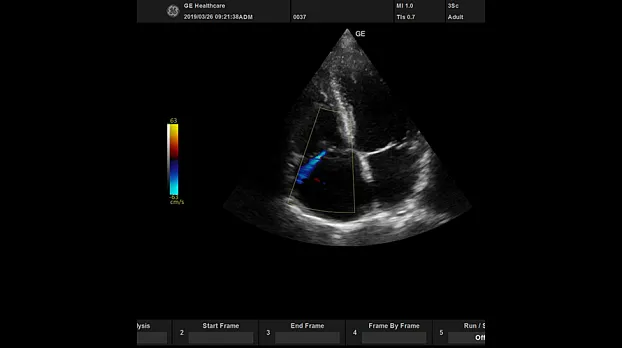 Клинические изображения УЗИ аппарат GE Healthcare Versana Active портативный