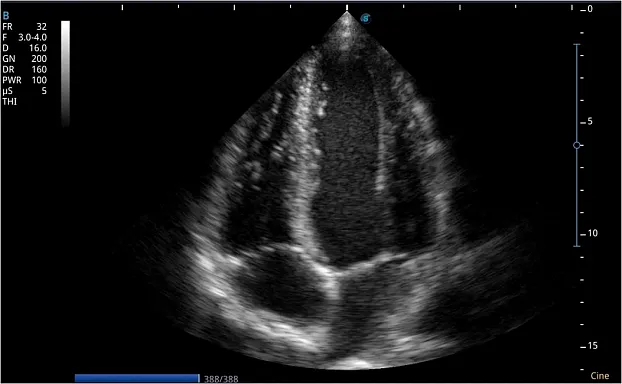 Клинические изображения Sonoscape E2 ультразвуковой аппарат