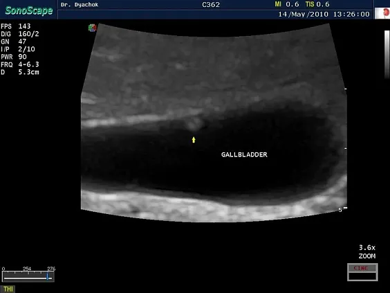 Клинические изображения Sonoscape S20 ультразвуковой аппарат